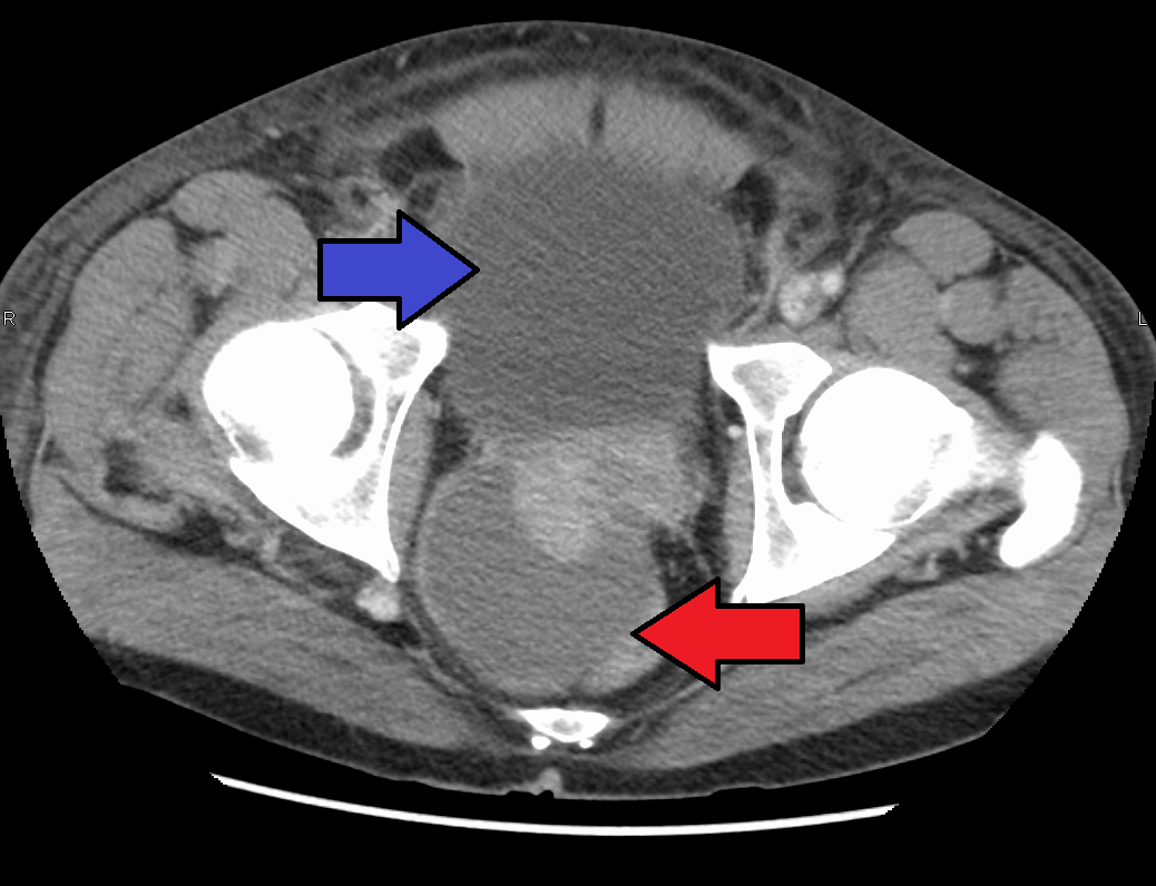 inflamarea prostatei