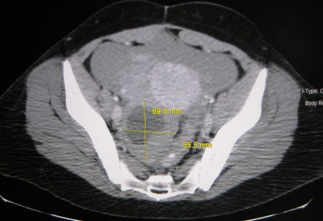 Chistul ovarian - află cum să recunoști simptomele și ce tratament este recomandat să iei