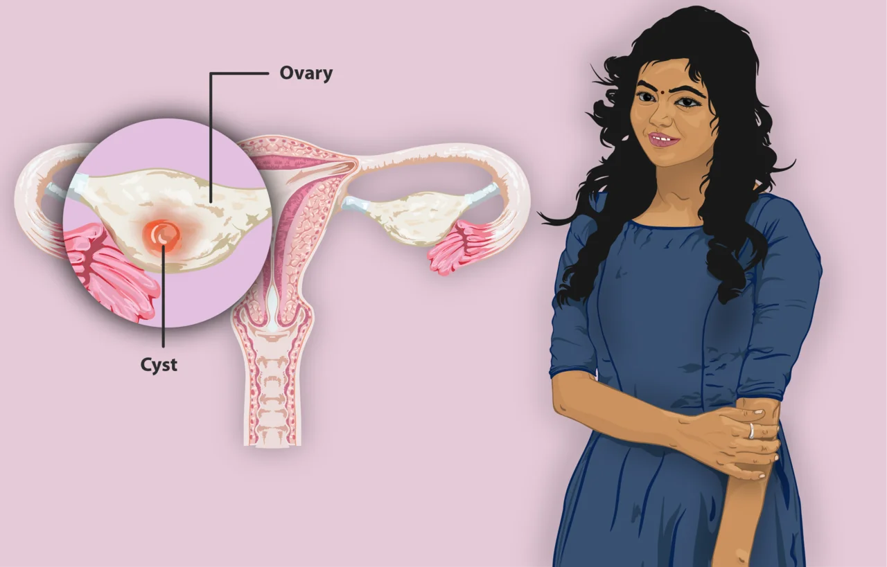 chist ovarian